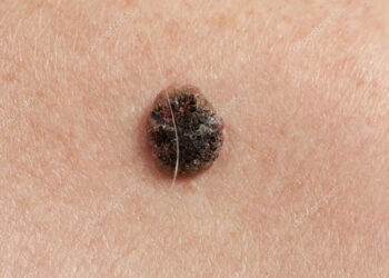 Squamous cell carcinoma treatment