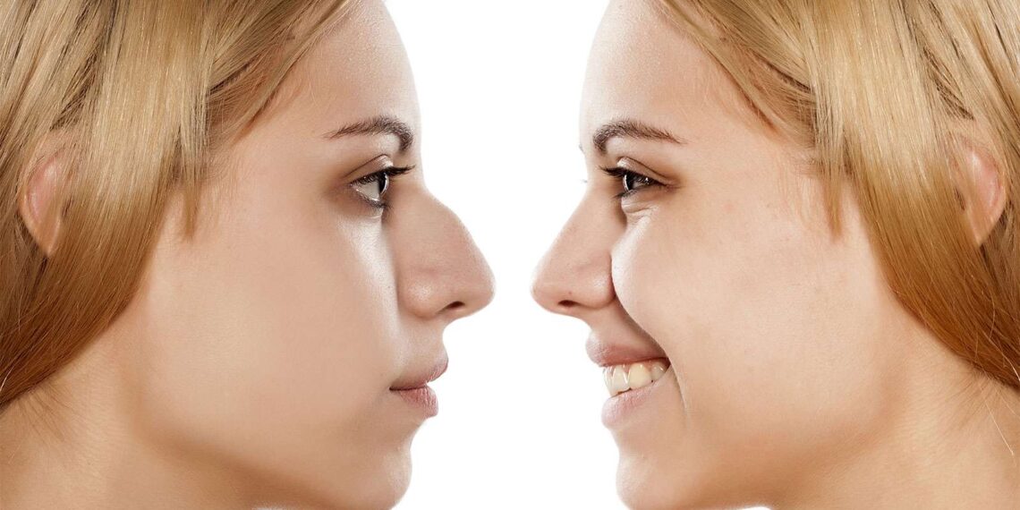 Rhinoplasty surgery