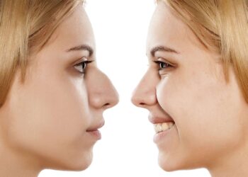 Rhinoplasty surgery