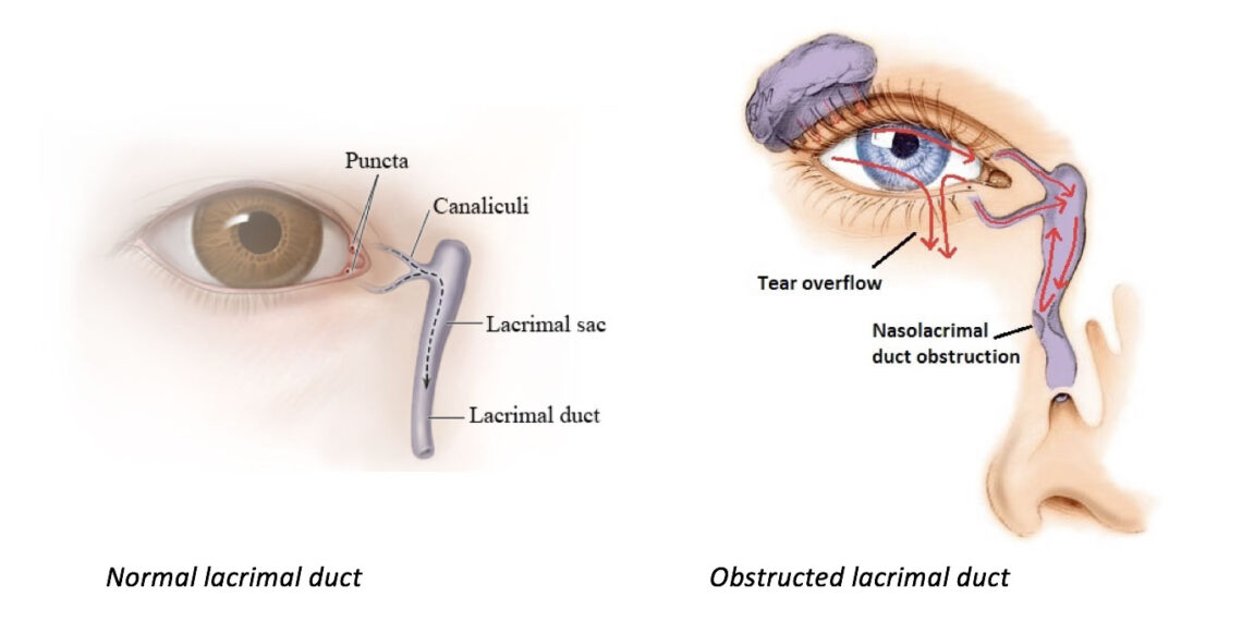 Lacrimal Duct Obstruction Surgery