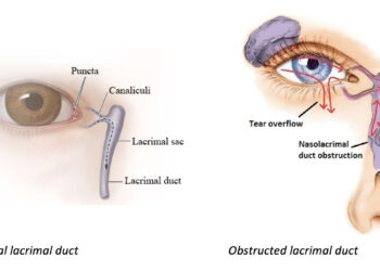 Lacrimal Duct Obstruction Surgery