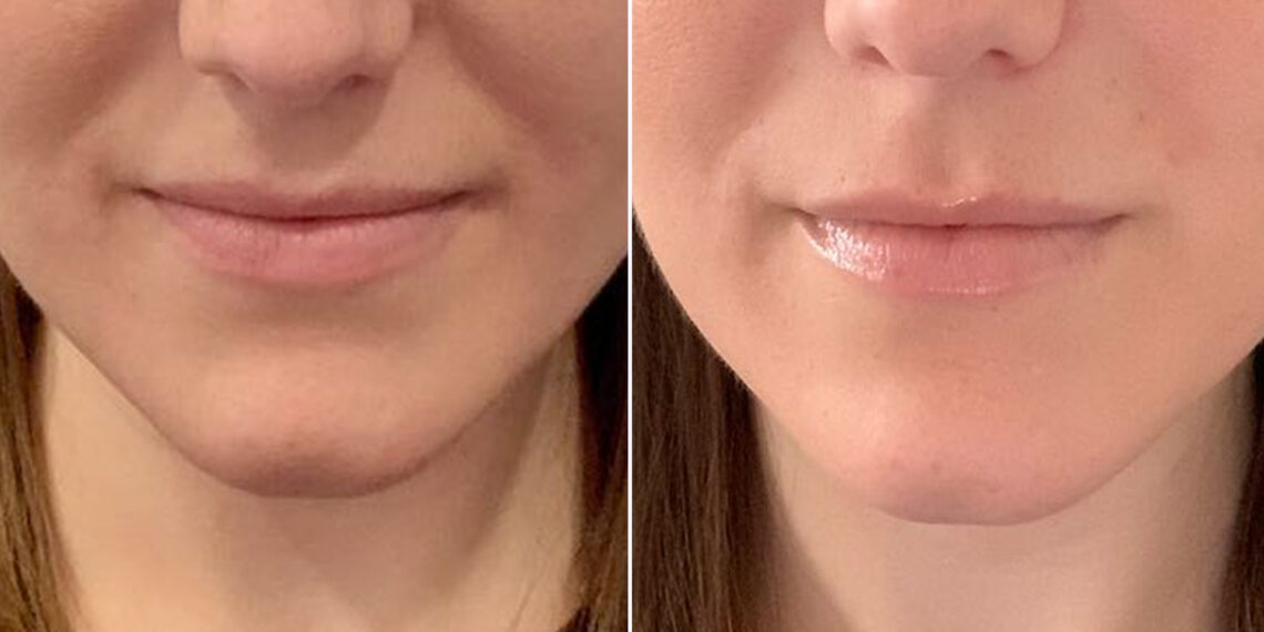 Nasolabial Folds Treatment
