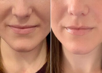 Nasolabial Folds Treatment