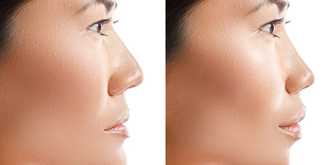 How to Get High Cheekbones?