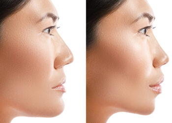 How to Get High Cheekbones?