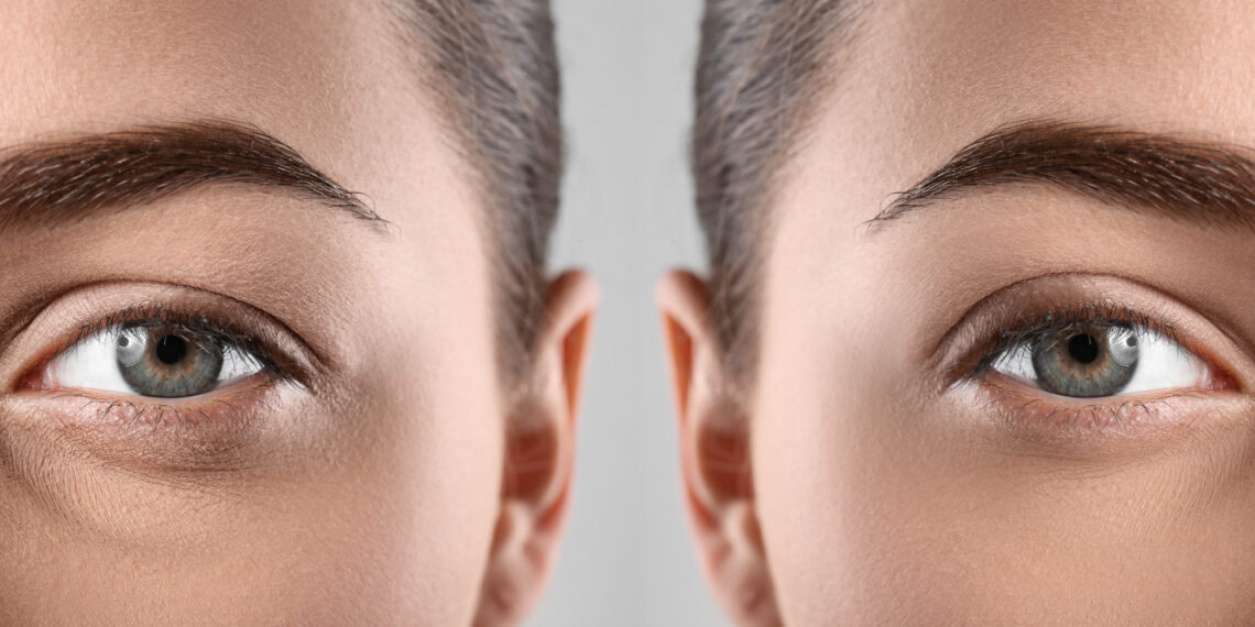 Lift Droopy Eyes with Minor Surgery