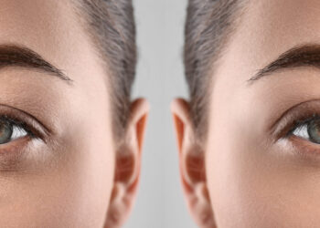 Lift Droopy Eyes with Minor Surgery