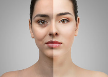 Cosmetic Eyelid Surgery