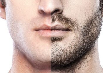 Beard-Transplant-in-mumbai-india