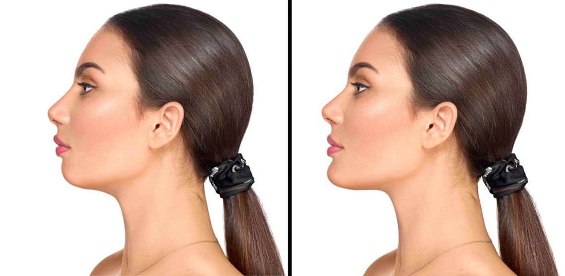 Best Chin Augmentation Surgery in Mumbai, India (Genioplasty Surgery)