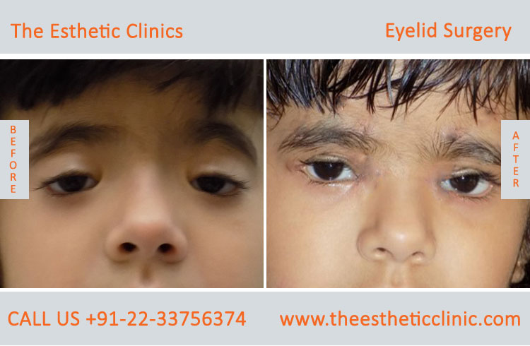 Best Eyelid Surgery in Mumbai, India