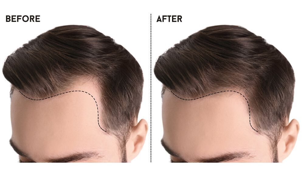 Is Hair Transplant Effective for Alopecia Areata?