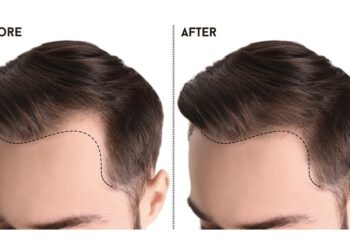Is Hair Transplant Effective for Alopecia Areata?