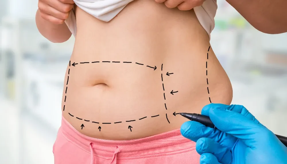 Tummy Tuck Surgery in India