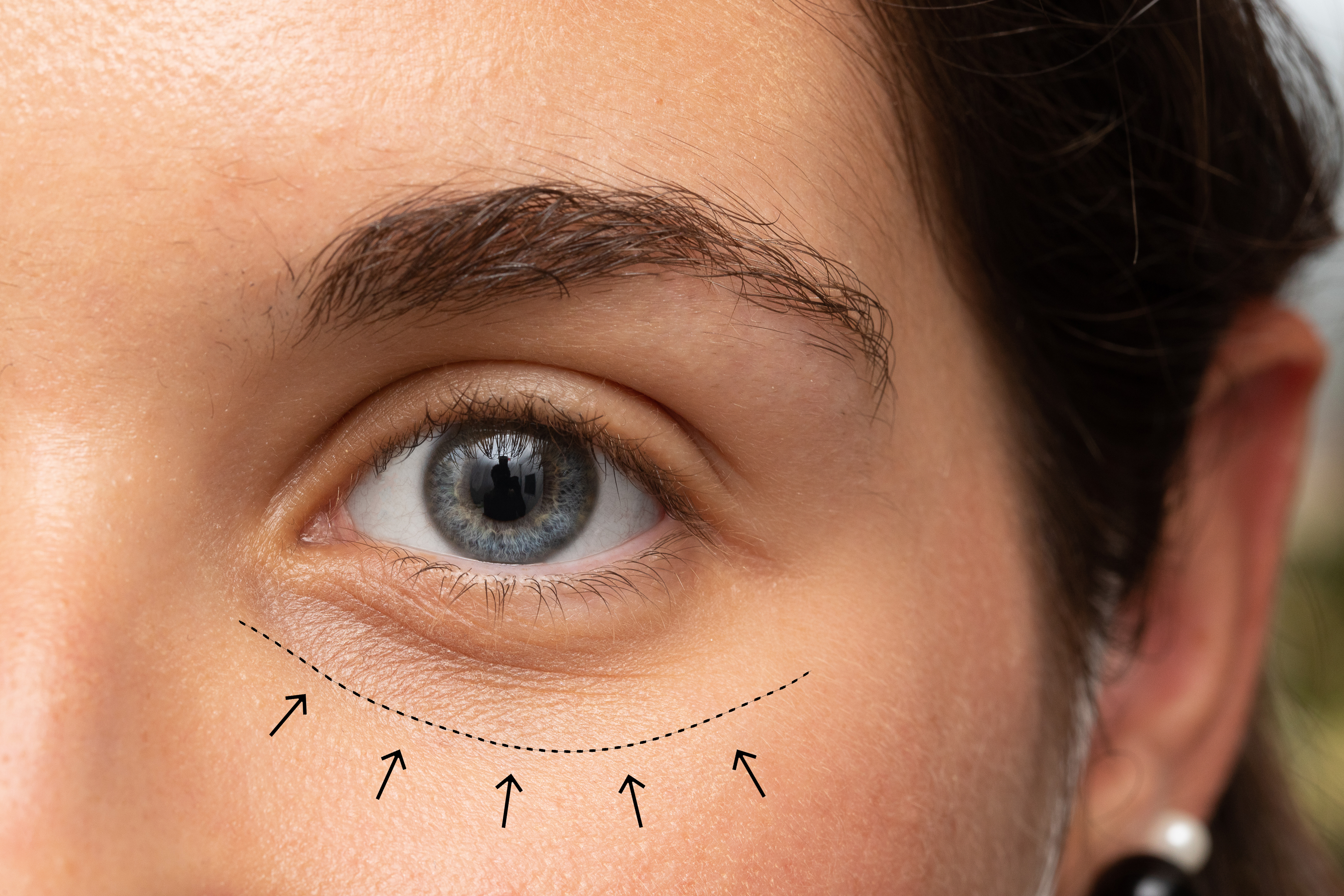 girl eye with lines and arrows indicating the correction of aest